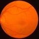 Idiopathic Central Serous Choroidopathy